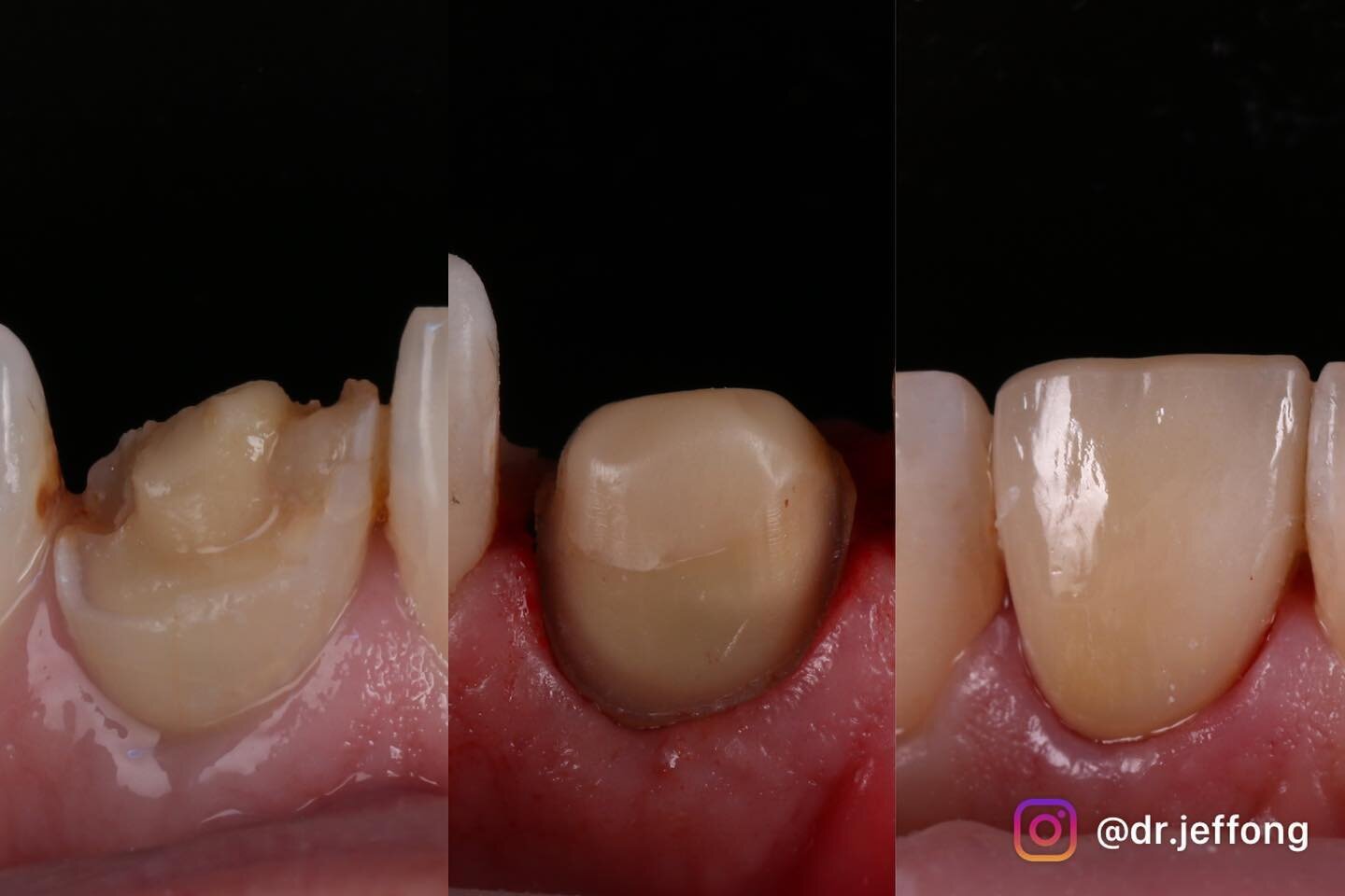 Accident-related front tooth fracture restored with e.max crown