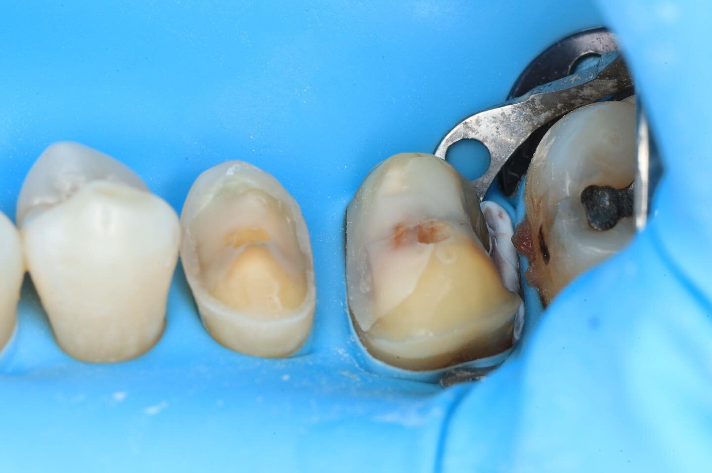 Cerasmart crownlays for teeth 15 and 16. Photos are hopefully self-explanatory. Dismantle, caries removal endpoint, deep margin elevation, teeth preparation and bonding of the final restorations.