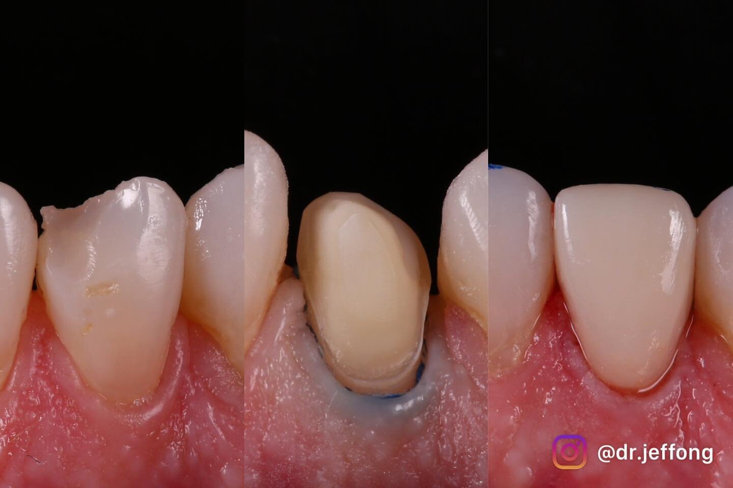 CEREC e.max veneer
Patient previously had a composite veneer which fractured, so we replaced it with ceramic veneer. The shade could be improved, but patient was happy with the outcome
