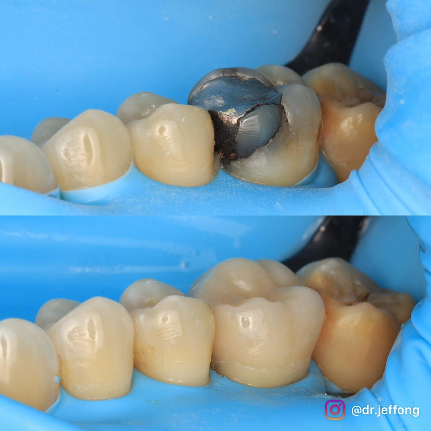 E.maximising a tooth 16 affected by cracked tooth syndrome