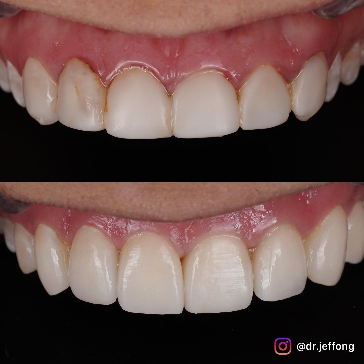 8 units of ceramic veneers to rejuvenate this patient&rsquo;s smile

Patient was initially referred to me because of her gum problem around her existing composite veneers. She was otherwise quite happy with them in terms of appearance. 

Gingivectomy