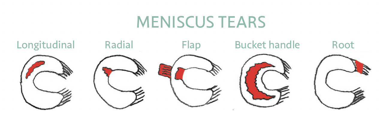 What are knee experts currently thinking about meniscus tears?