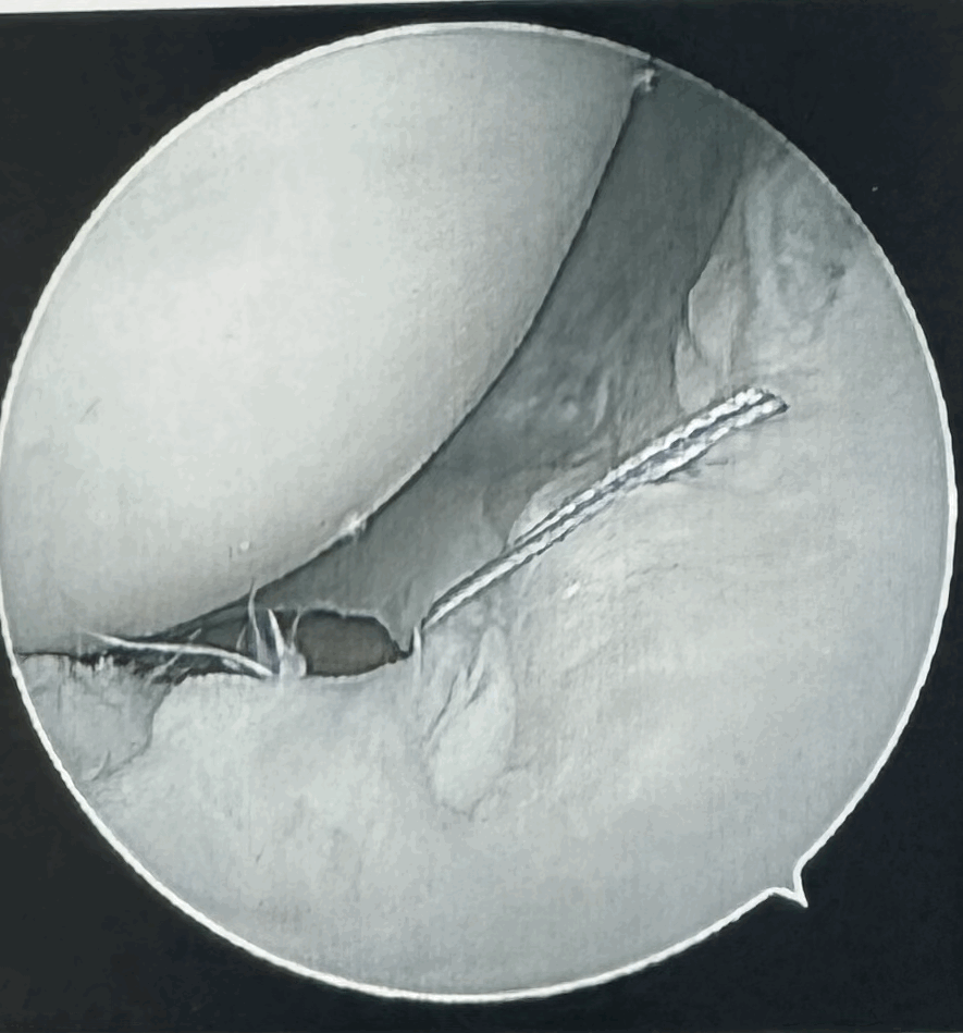 When Arthroscopy Makes Osteoarthritis Worse: An Evidence-Based Review (2026 Guide)