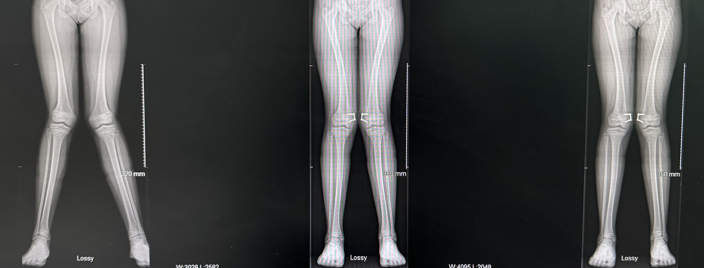 Geni valgum knock knee correction 8 plates