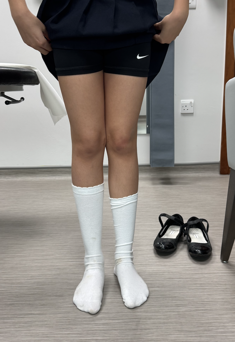 Genu valgum after femoral 8 plate correction