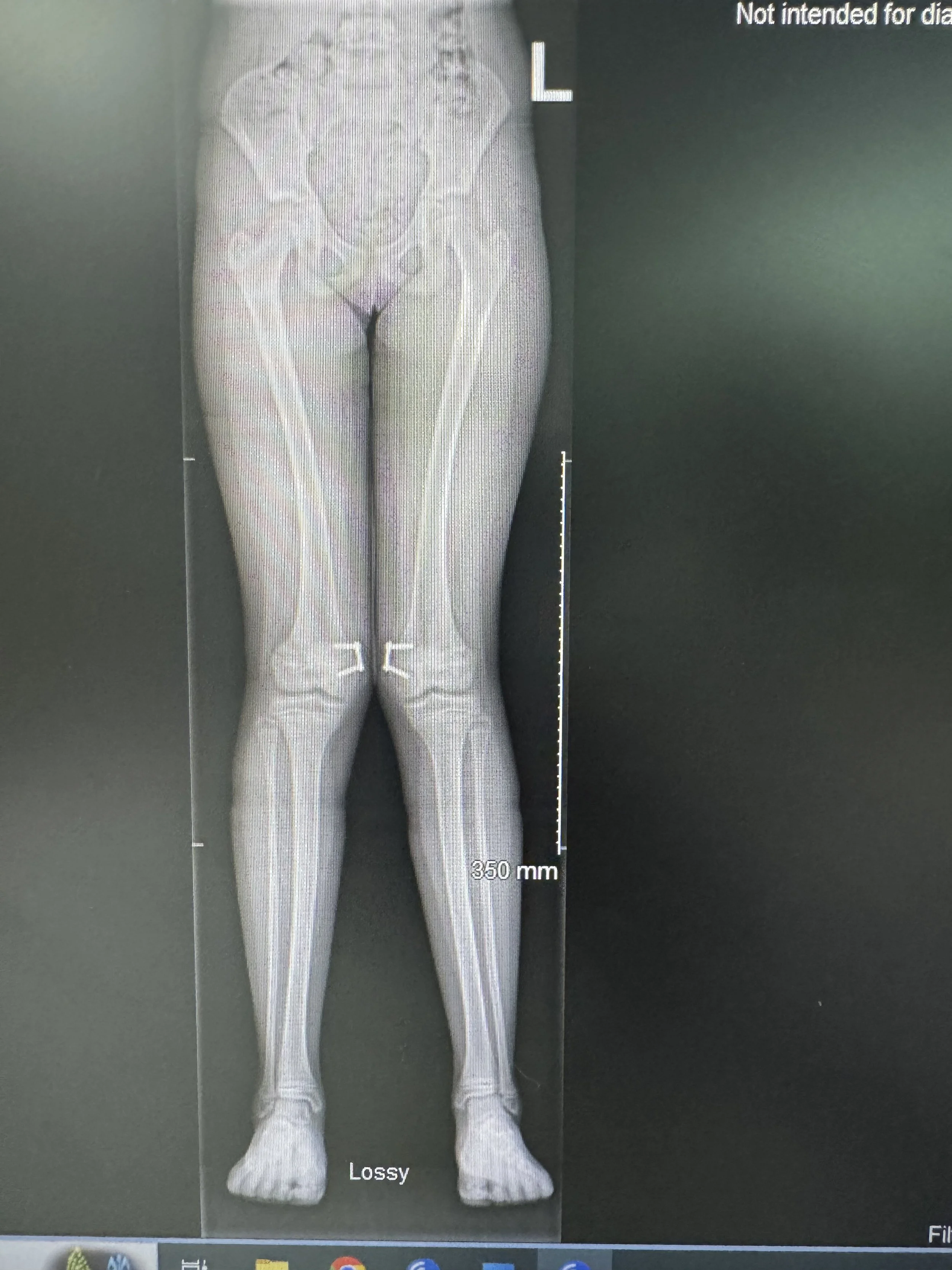 Femoral 8 plates for genu valgum