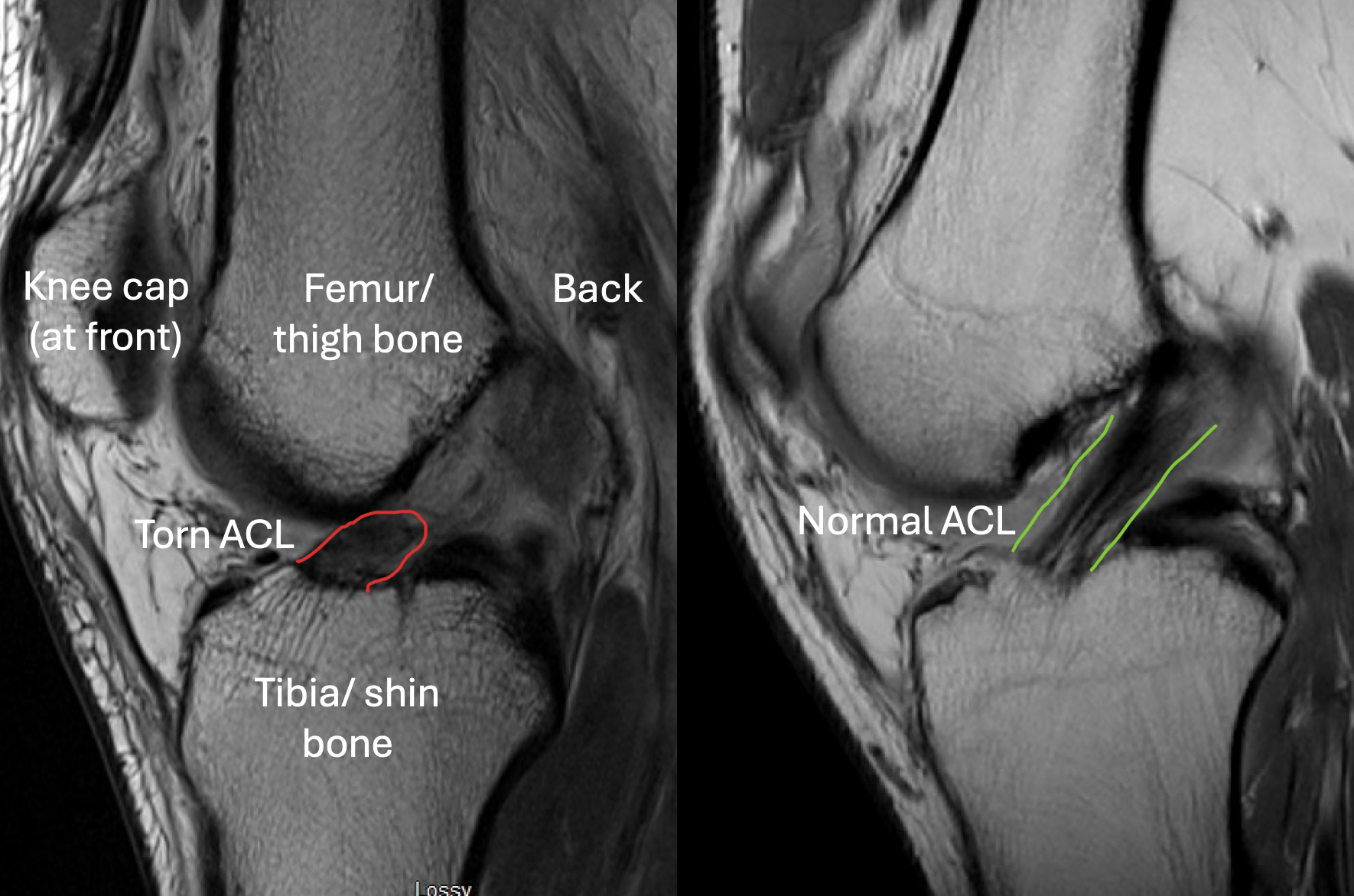 ACL tear on MRI