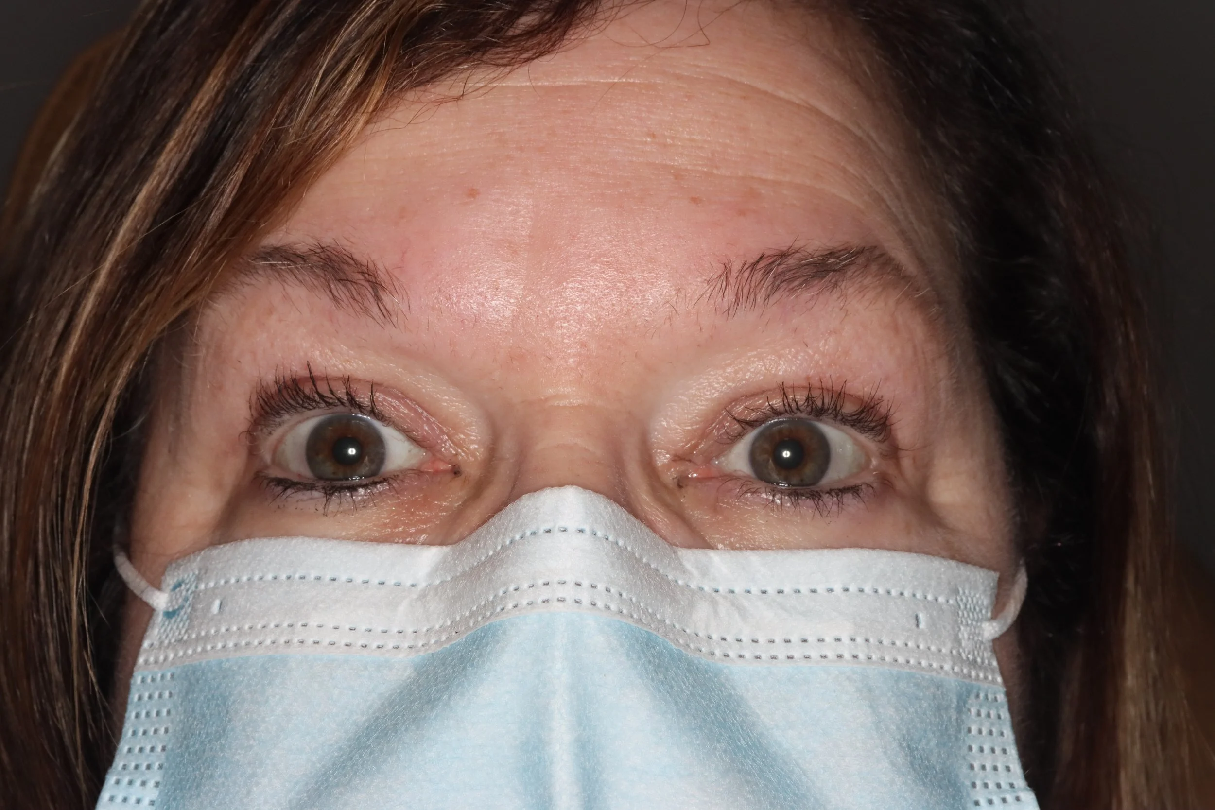 After: upper eyelid blepharoplasty