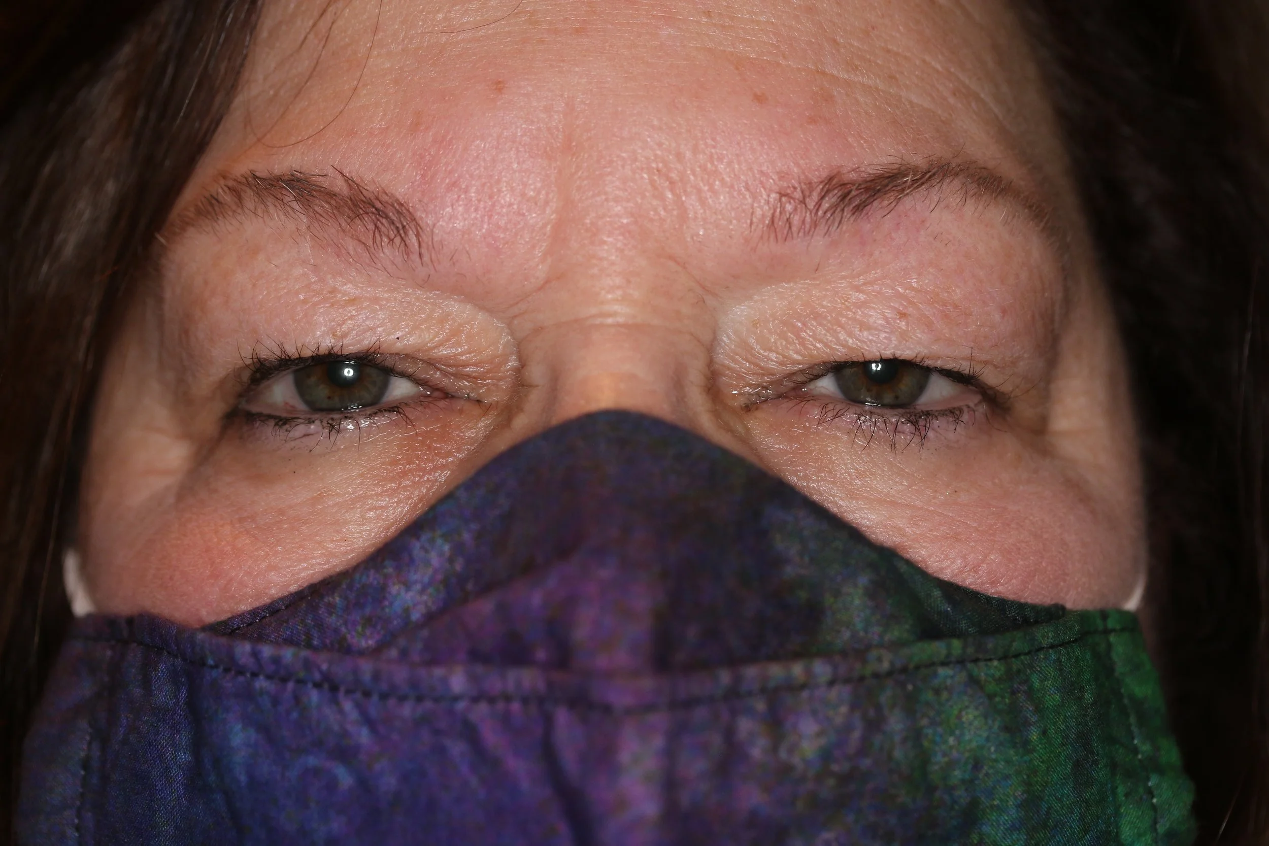 Before: Upper eyelid blepharoplasty