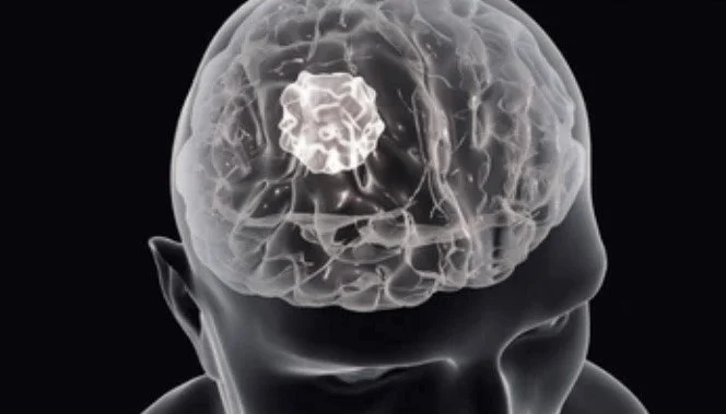 Advanced Neurosurgical Oncology Simulation Course