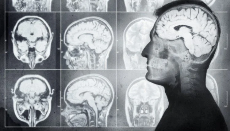 Queen Square Interventional Neuroradiology Symposium