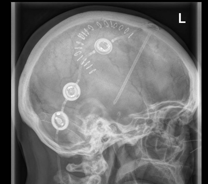 Hydrocephalus Simulation Course