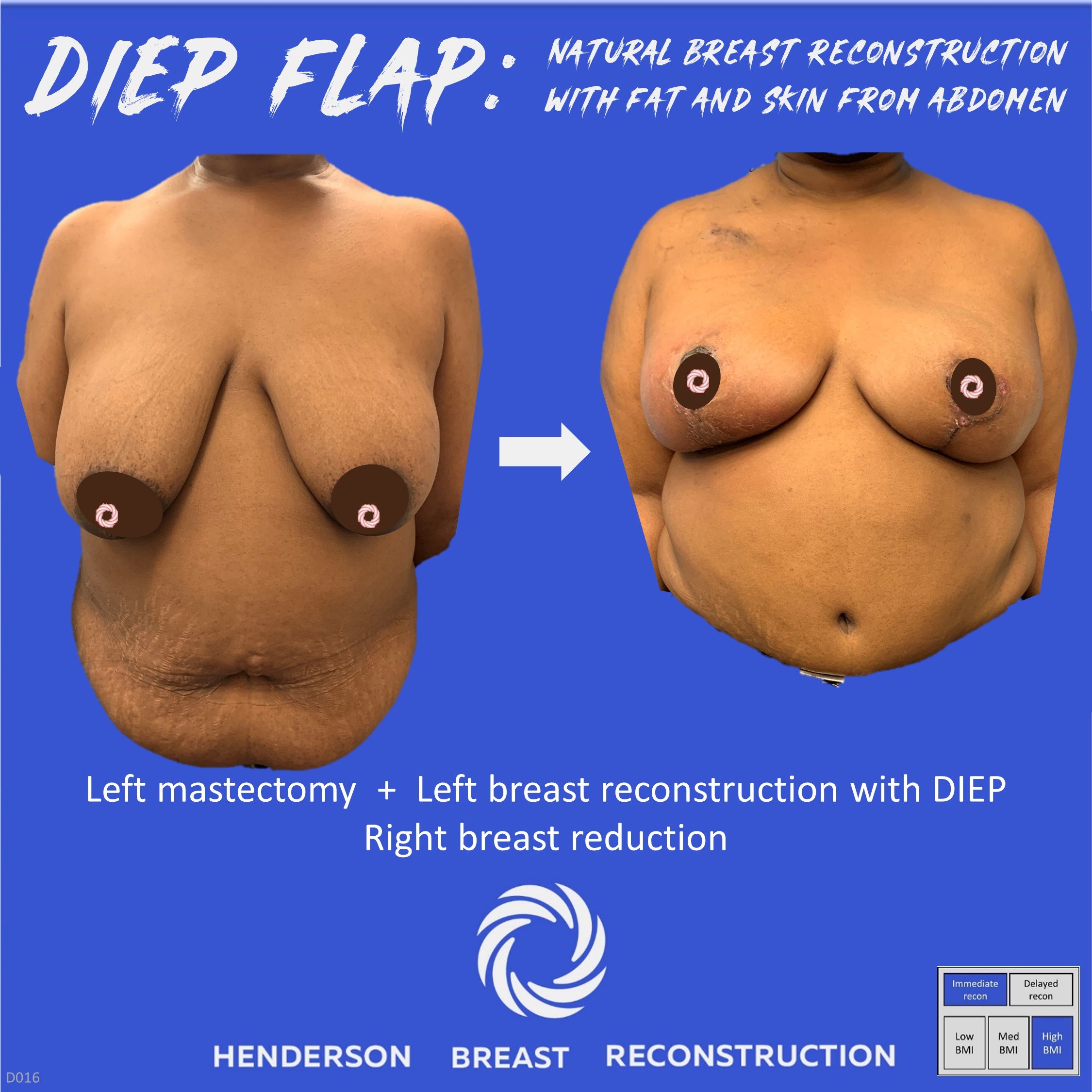 Image of delayed DIEP breast reconstruction (left breast) and