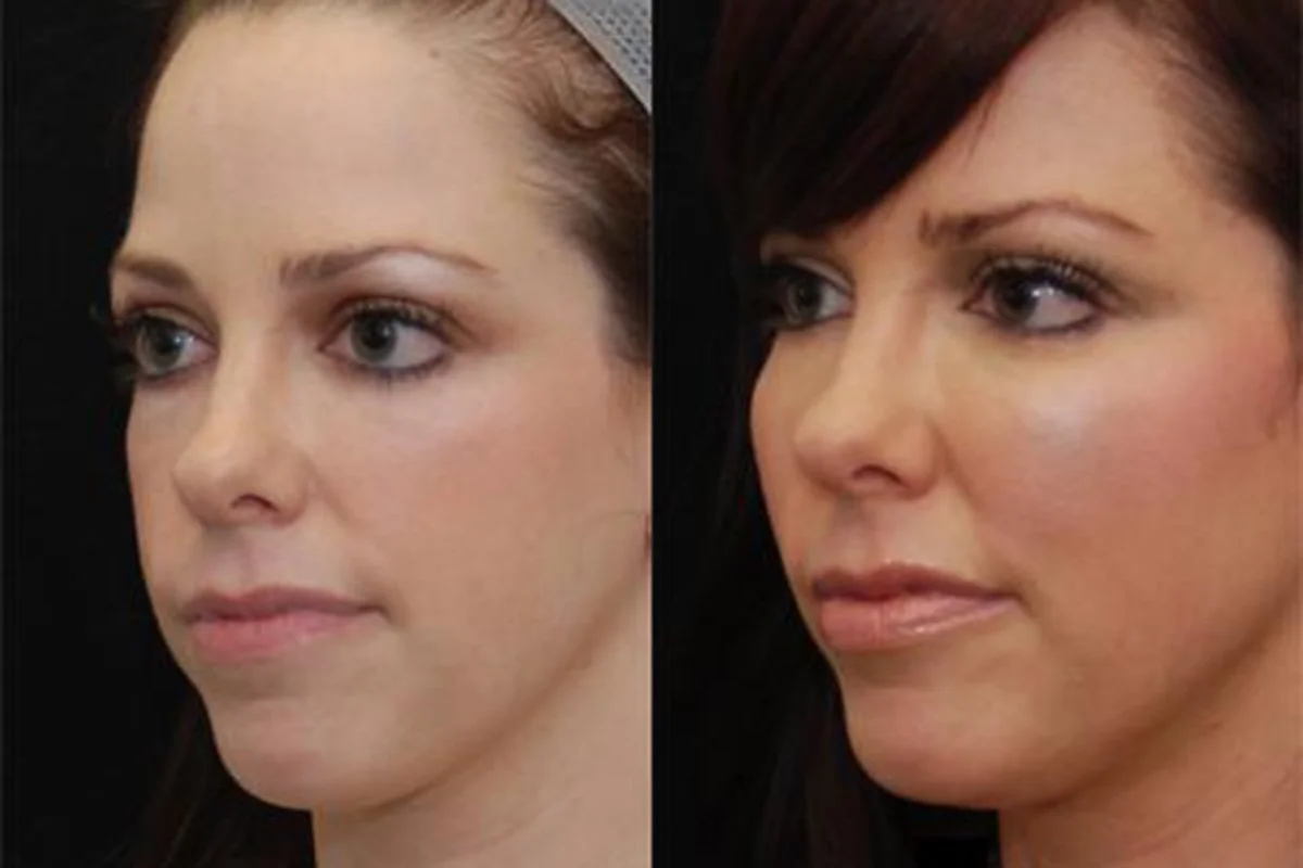 What is Fat Grafting? Fat Grafting Recovery Time Fat Grafting