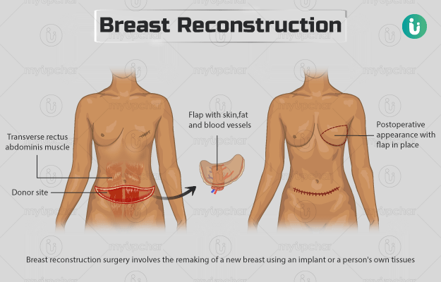Breast reconstruction with latissimus dorsi and implant insertion
