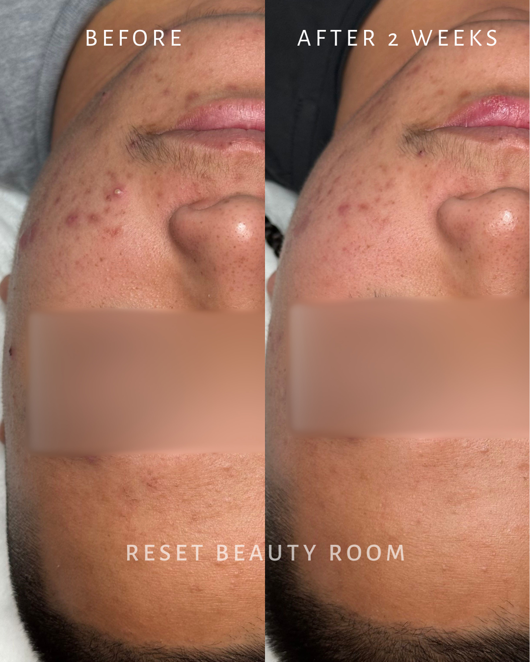 1 x Complexion Reset + Oxygen Infusion + Nordic Detox Mask + Extractions