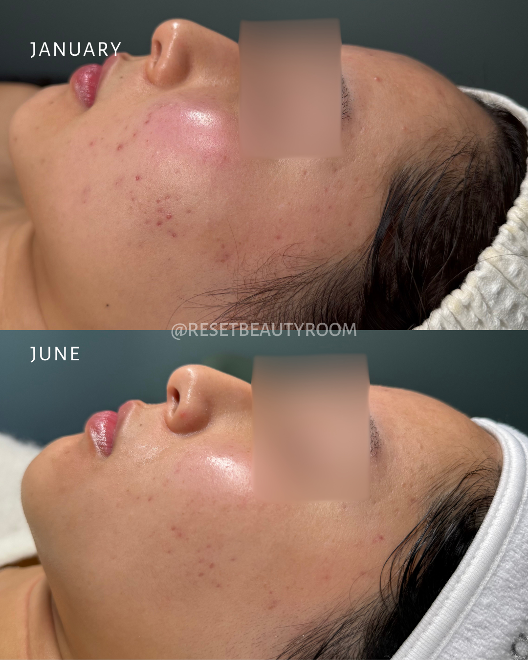 1 x Complexion Reset, 
1 x Hydroglow, 
3 x Advanced Microneedling, 
1 x LED Express Facial