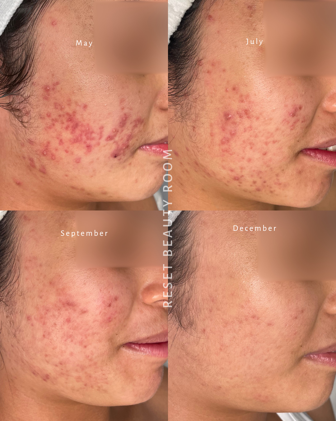 4 x LED Express Facials
5 x Custom Skin Reset Peels