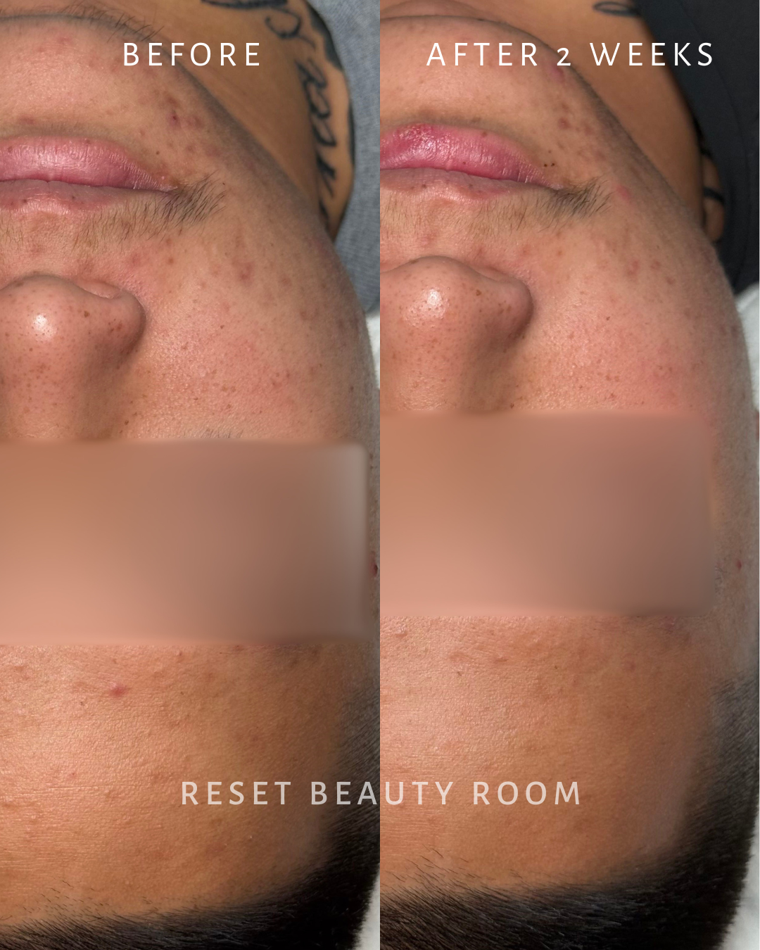 1 x Complexion Reset + Oxygen Infusion + Nordic Detox Mask + Extractions