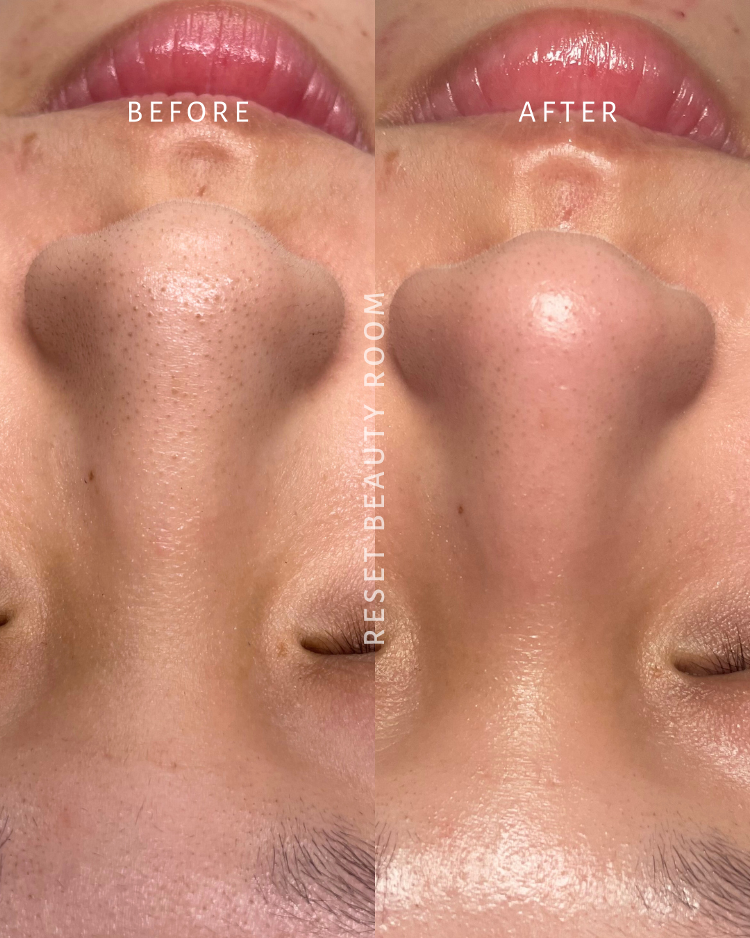 1 x LED Express Facial with Extractions