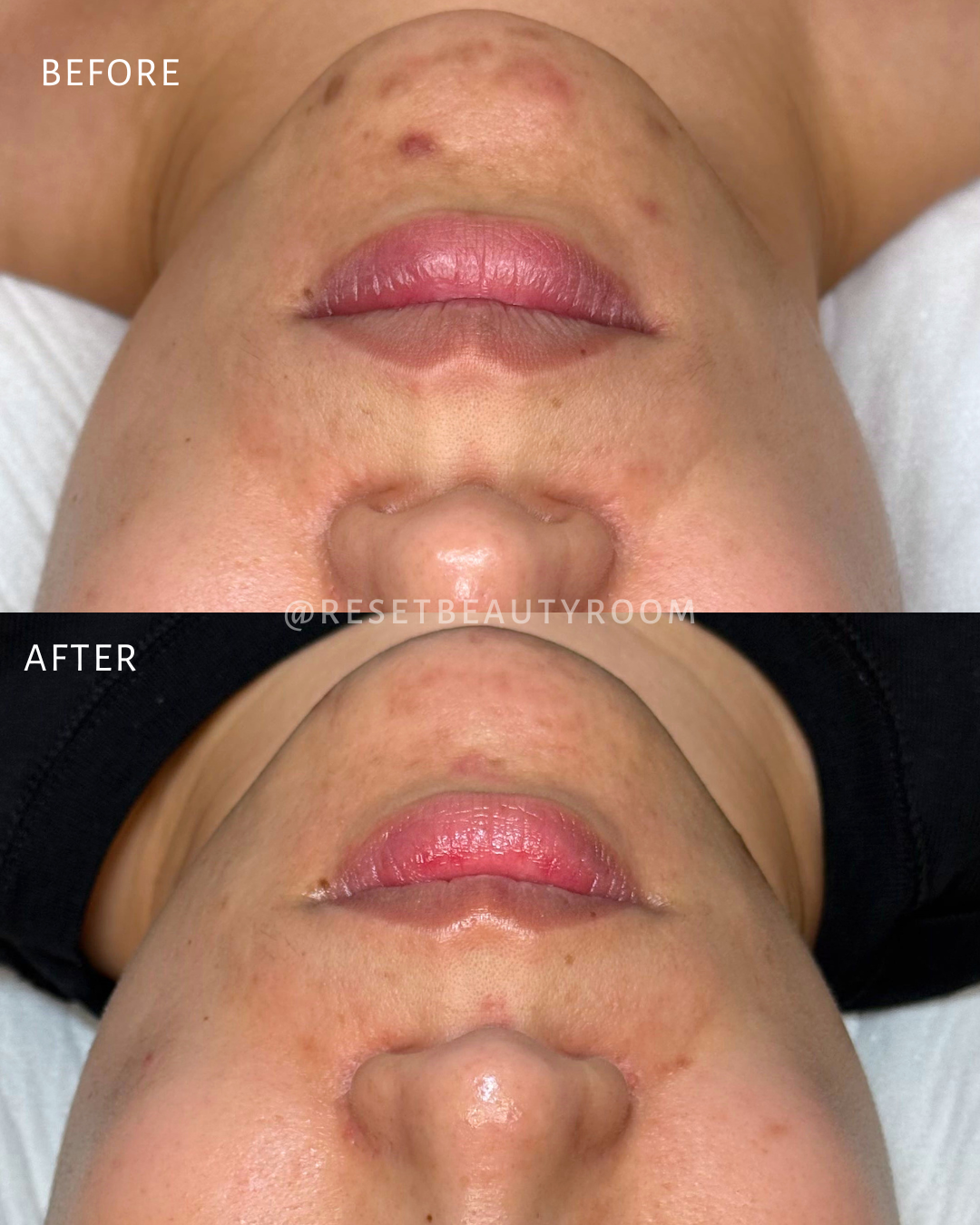 1 x Complexion Reset + Upgrades
2 x Hydroglow + Upgrades
1 x LED Express Facial
2 x Fusion Mesotherapy Microneedling