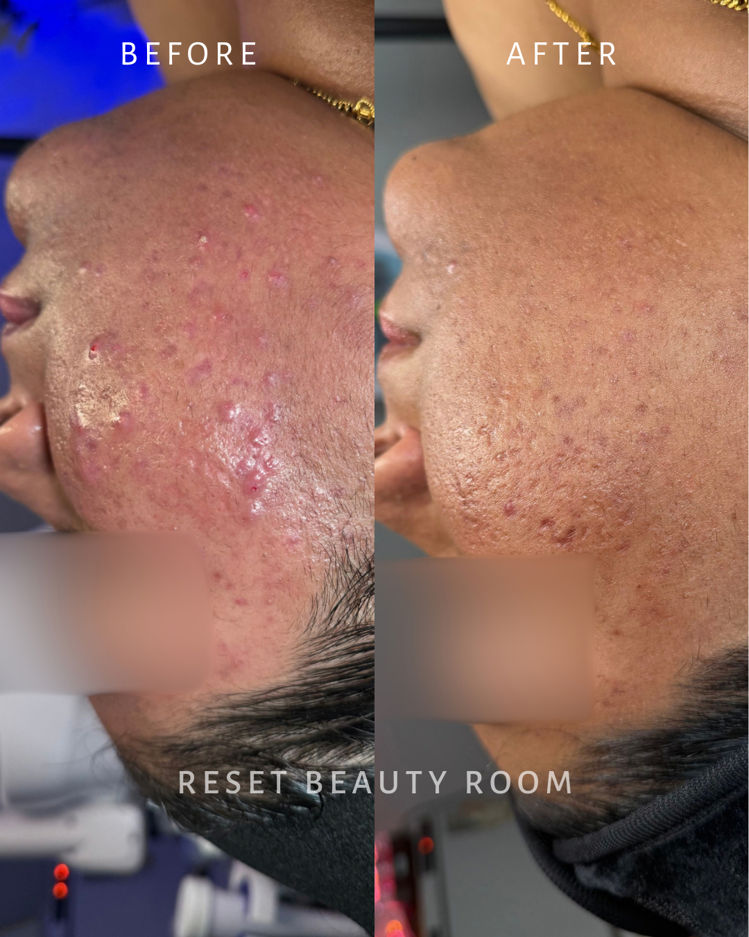 2 x Complexion Reset + Oxygen Infusion + LED, 
1 x Hydroglow Reset + Oxygen Infusion