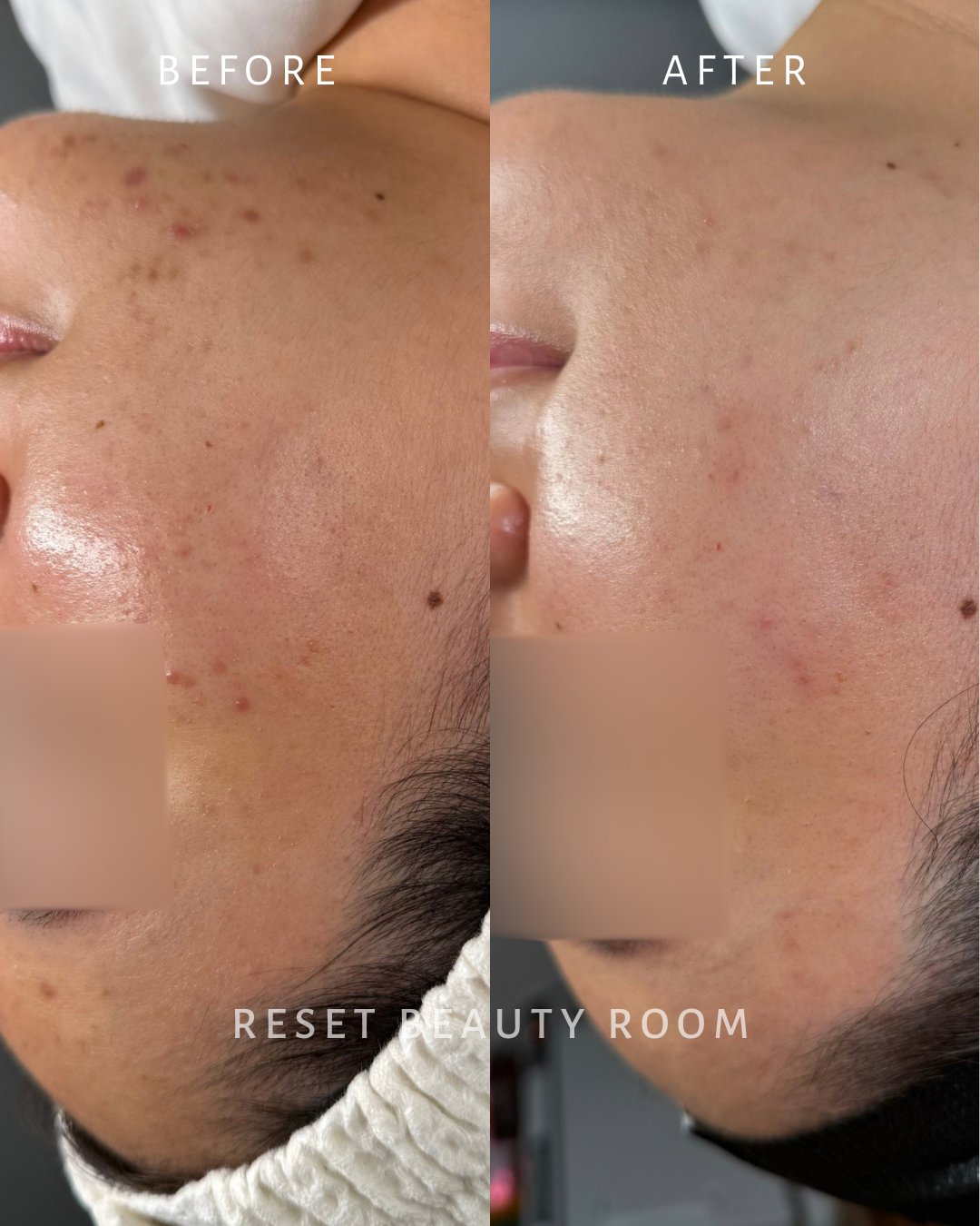 3 x Complexion Reset, 
1 x Hydroglow, 
3 x LED Express Facial, 
3 x Hydroglass, 
5 x Fusion Mesotherapy Microneedling.