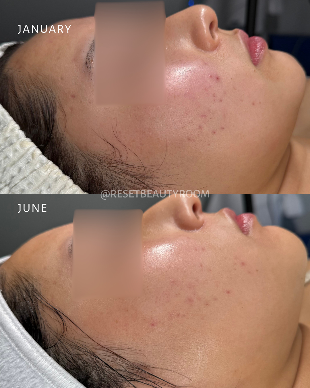 1 x Complexion Reset, 
1 x Hydroglow, 
3 x Advanced Microneedling, 
1 x LED Express Facial