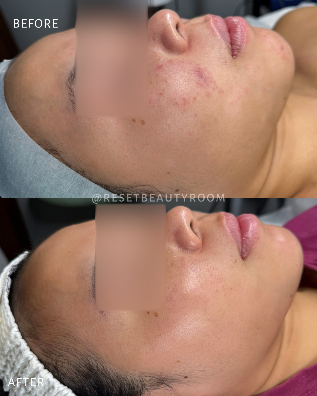 2 x Custom Skin Reset, 
1 x LED + Oxygen Infusion + Electroporation,
3 x Fusion Mesotherapy Microneedling,
1 x Moisture Infusion, 
2 x Hydroglass Facial