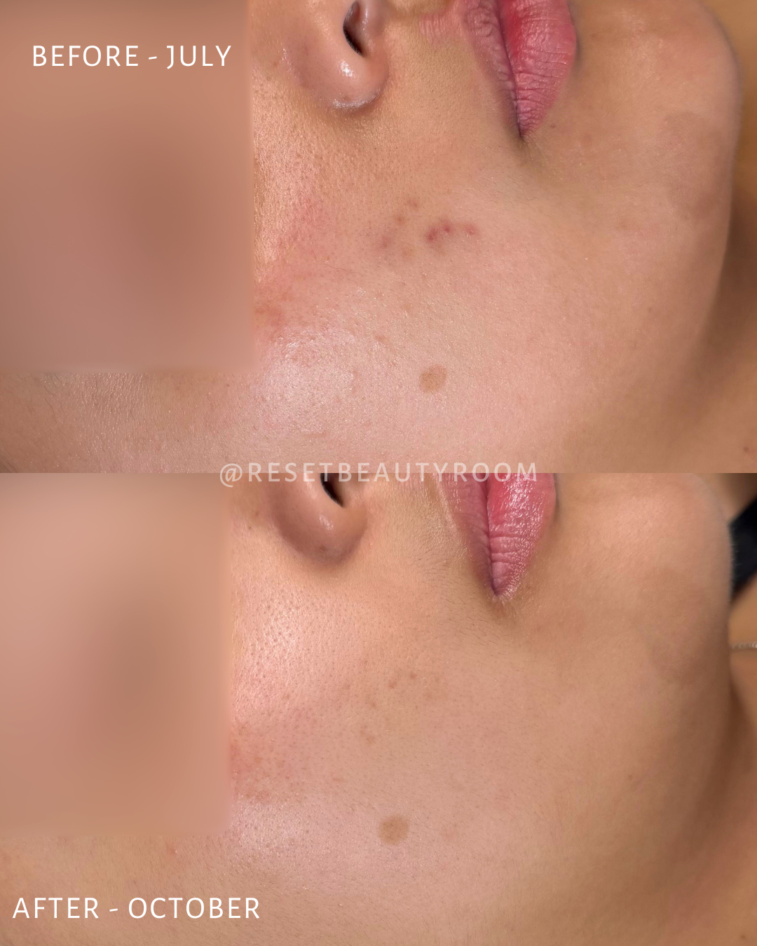2 x Complexion Reset + Oxygen Infusion + Extractions
1 x Hydroglow + Peel Upgrade + Oxygen Infusion
