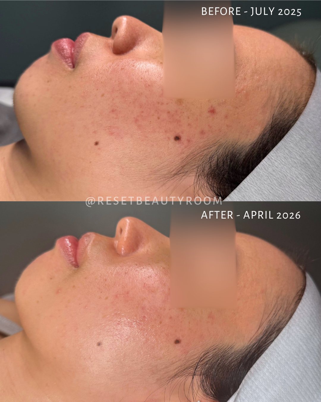6 x Fusion Mesotherapy Microneedling, 
1 x Hydroglow Reset, 
1 x Hydroglass Reset