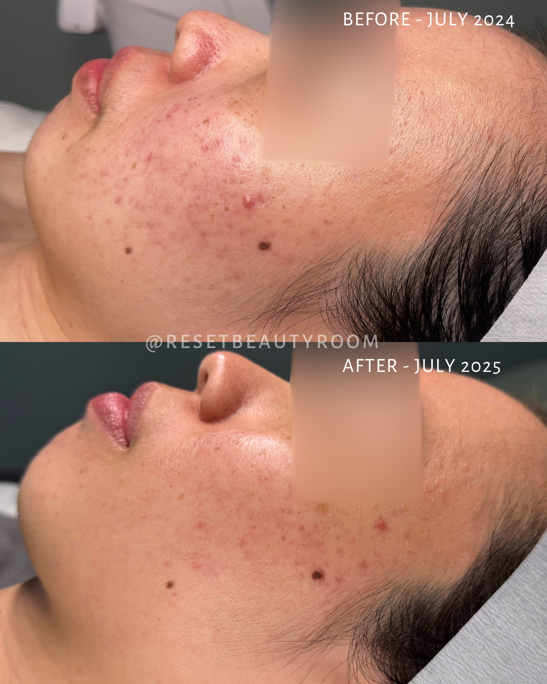 2 x Advanced Microneedling, 
1 x Complexion Reset, 
2 x Hydroglow,
4 x Fusion Mesotherapy Microneedling, 
1 x LED Express Facial