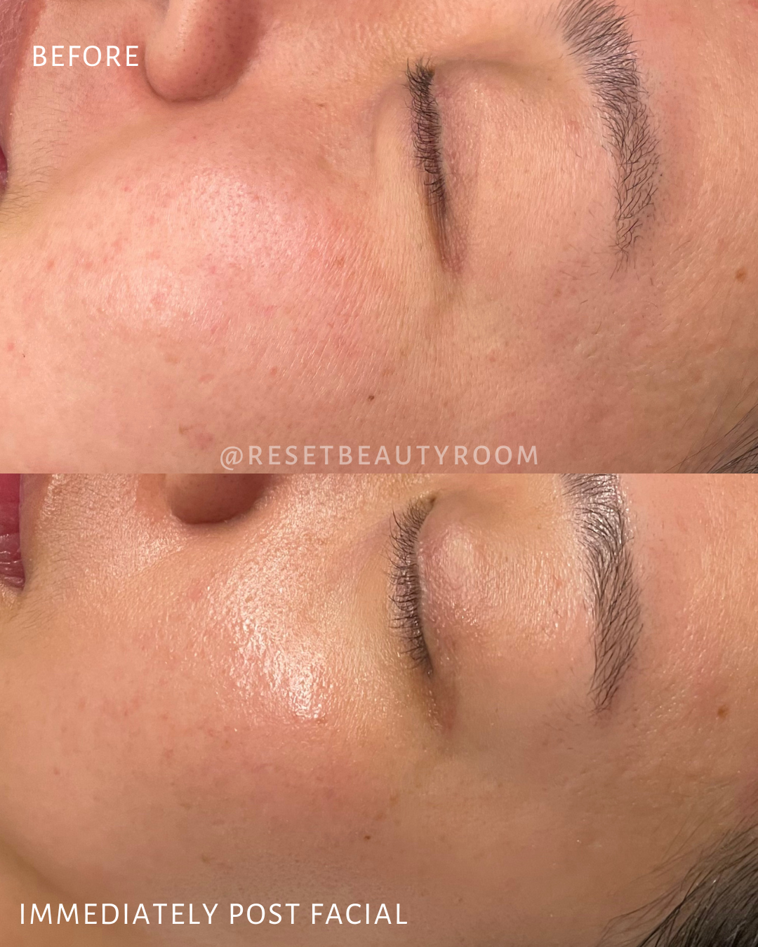 1 x Collagen Facial