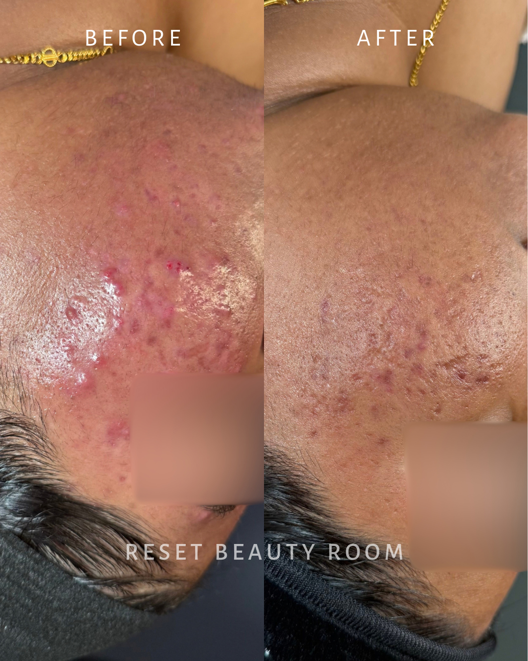 2 x Complexion Reset + Oxygen Infusion + LED, 
1 x Hydroglow Reset + Oxygen Infusion
