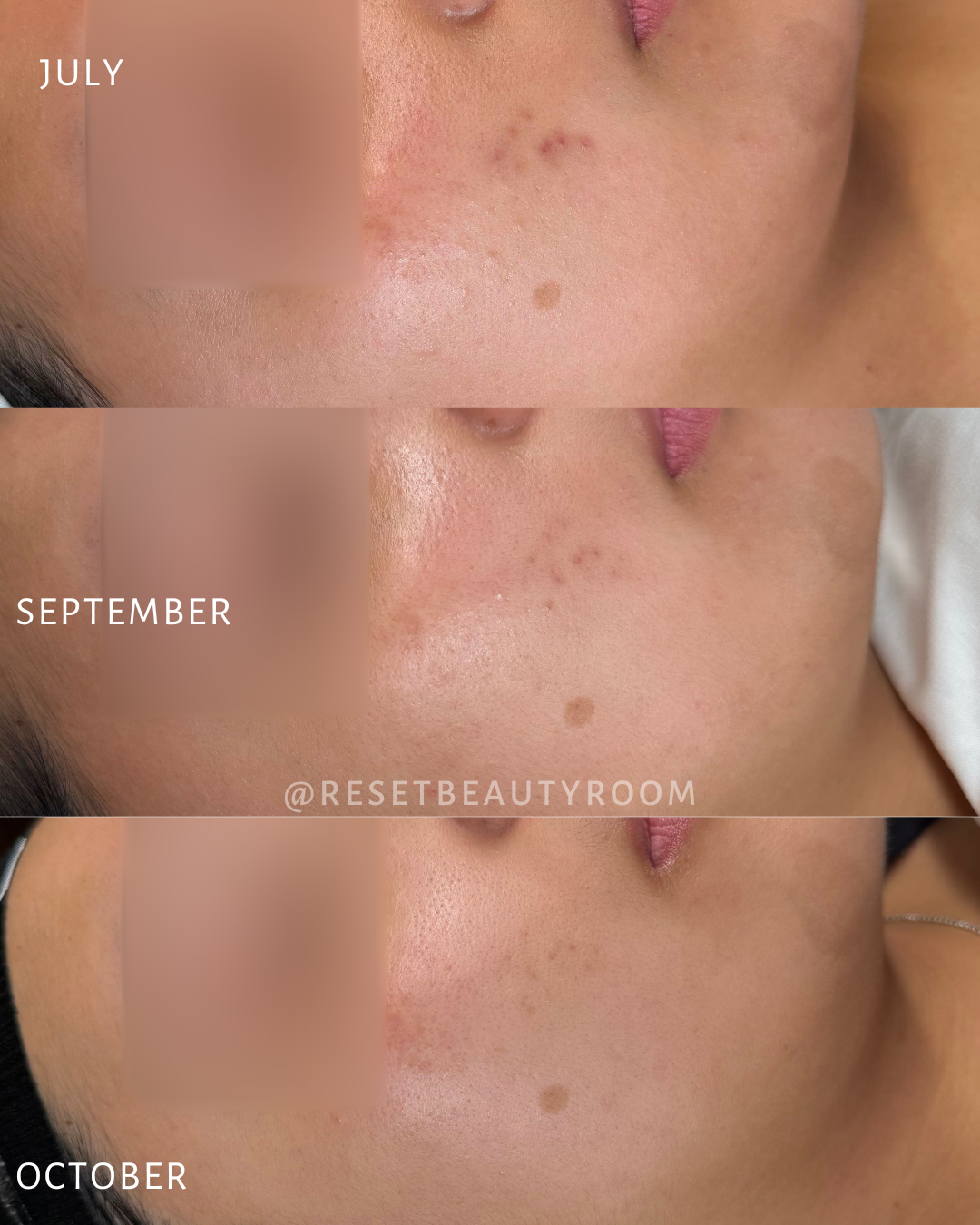 2 x Complexion Reset + Oxygen Infusion + Extractions
1 x Hydroglow + Peel Upgrade + Oxygen Infusion