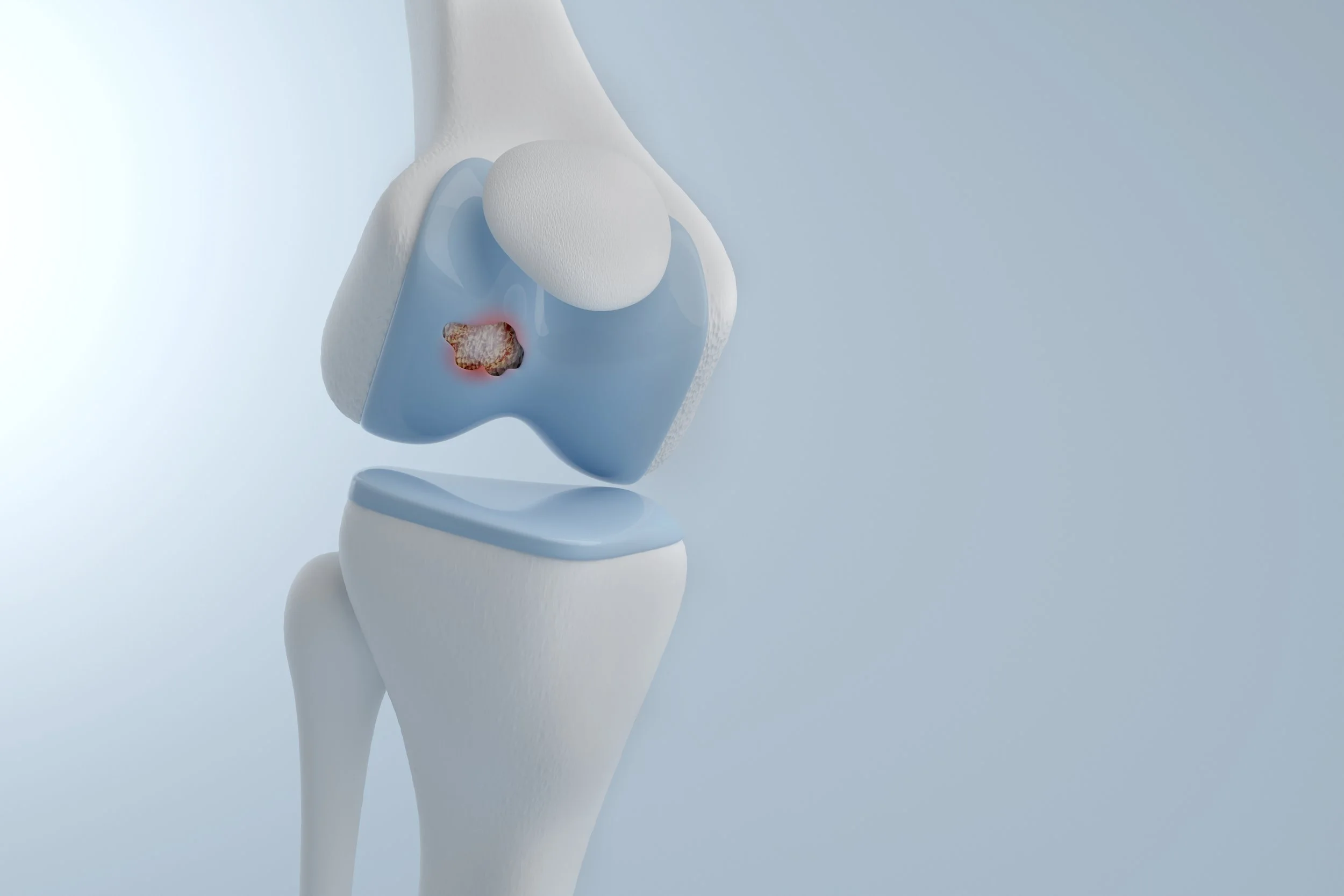 Rodilla con lesión en el cartílago