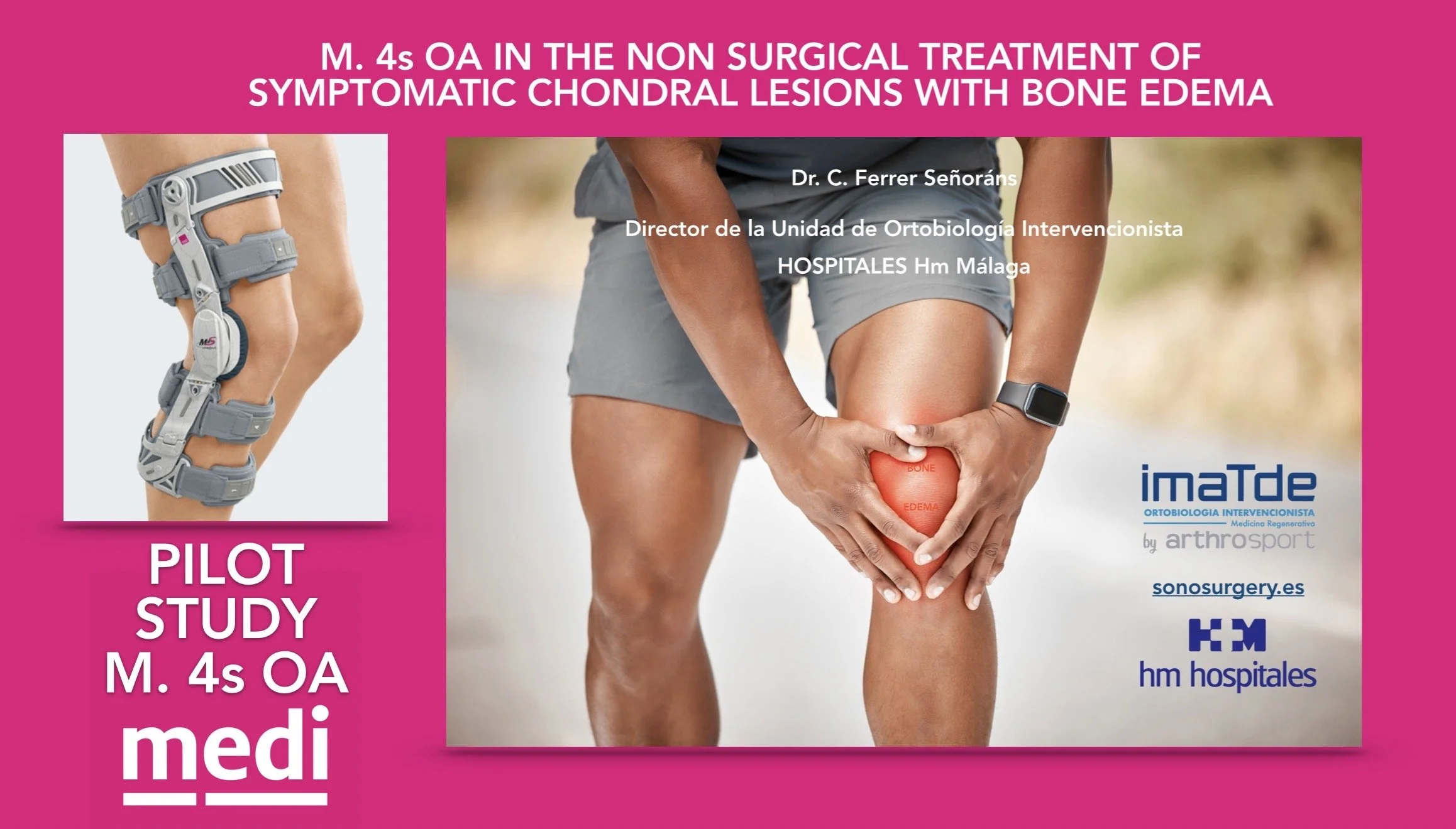 Órtesis M.4s OA junto al tratamiento ortobiológico en artrosis de rodilla con edema óseo