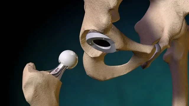 Prótesis de cadera por vía anterior: qué es y por qué facilita la recuperación