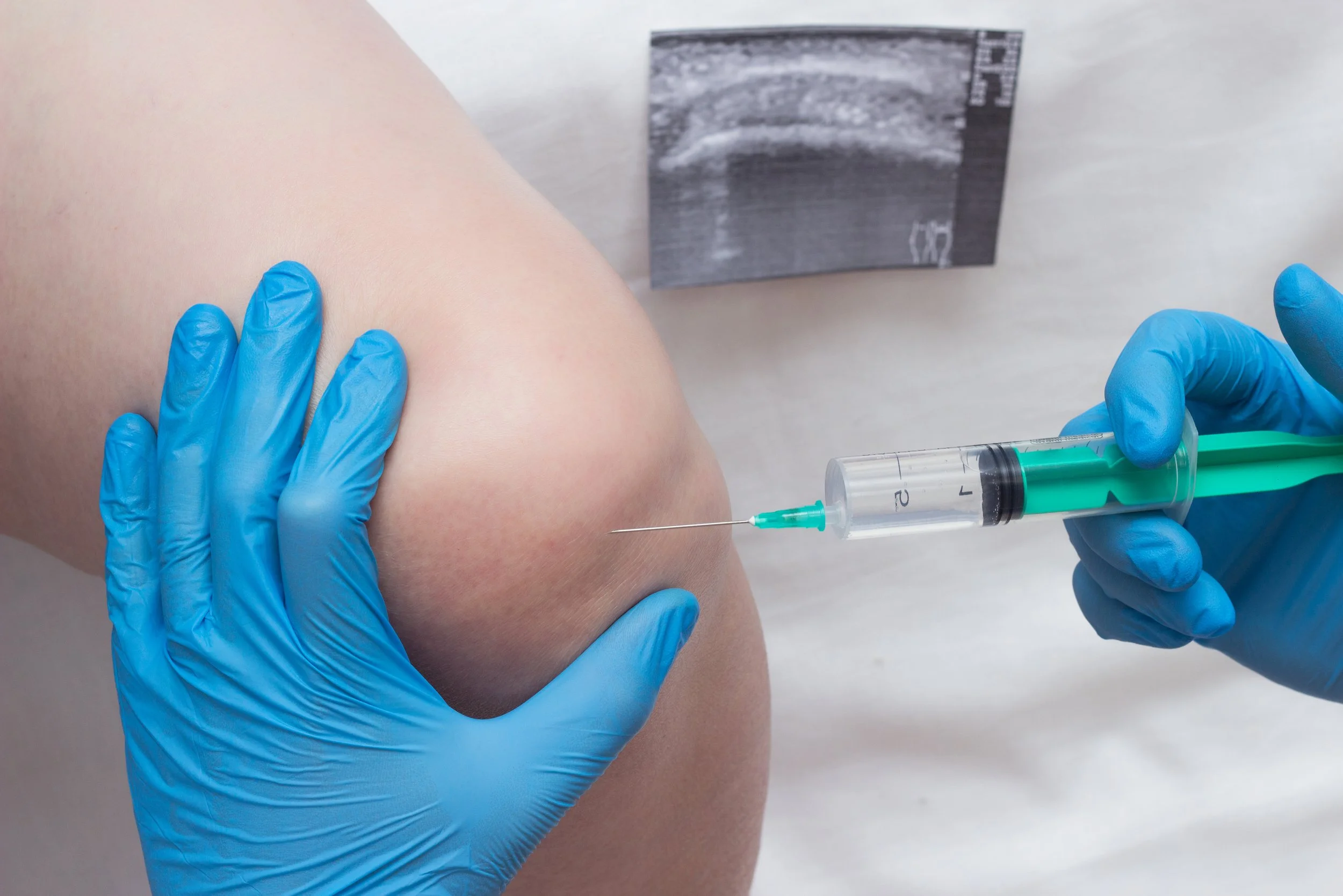 Infiltración ecoguiada en rodilla con ácido hialurónico.