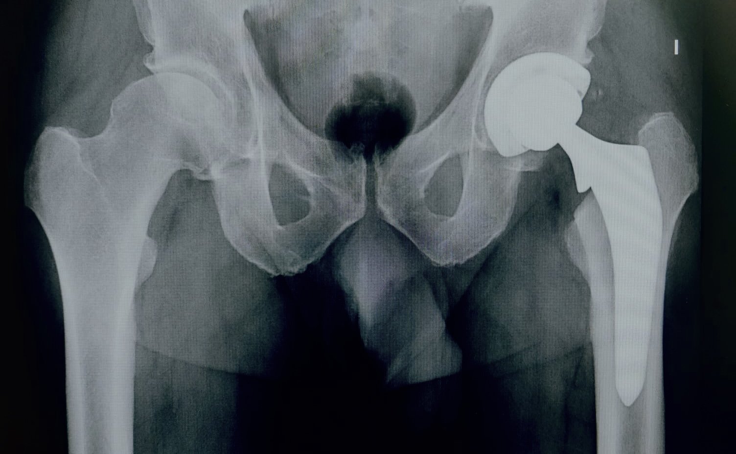 Radiografía de una prótesis de cadera puesta por la vía anterior en Málaga