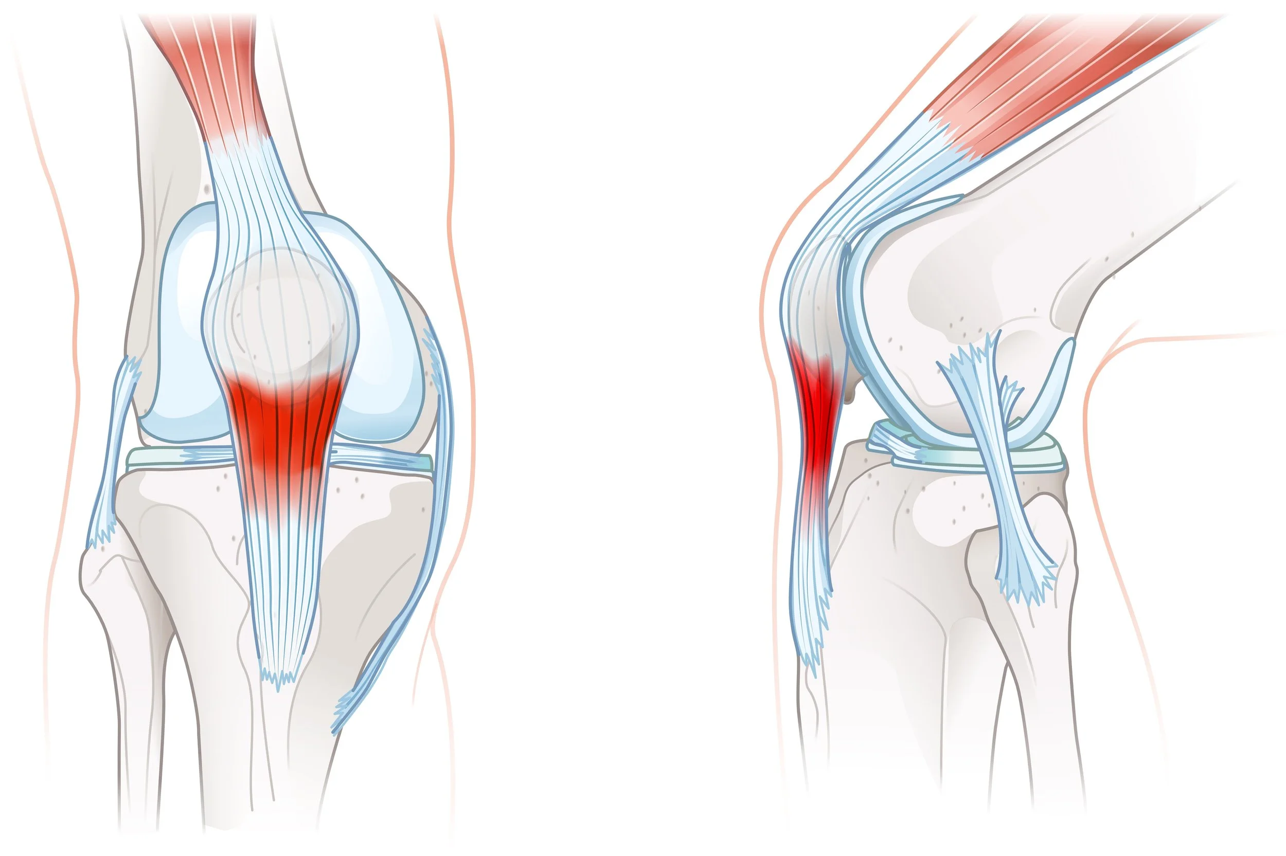 Ilustración de rodilla con una tendinopatía rotuliana