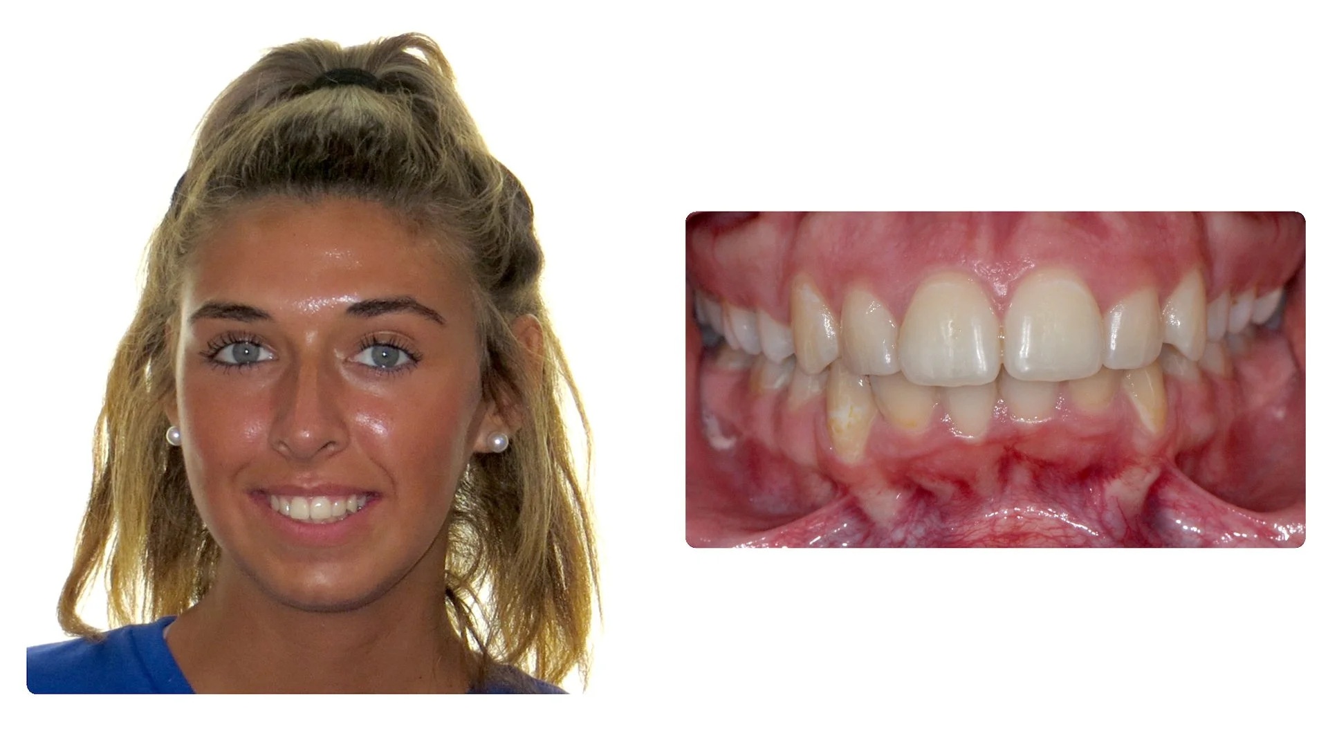 Alexis after braces photo