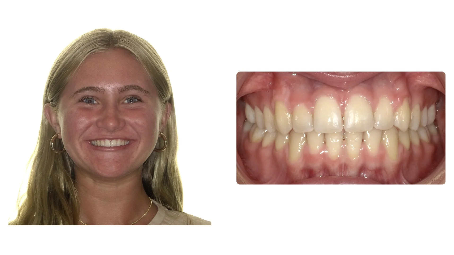 Rebecca before braces photo
