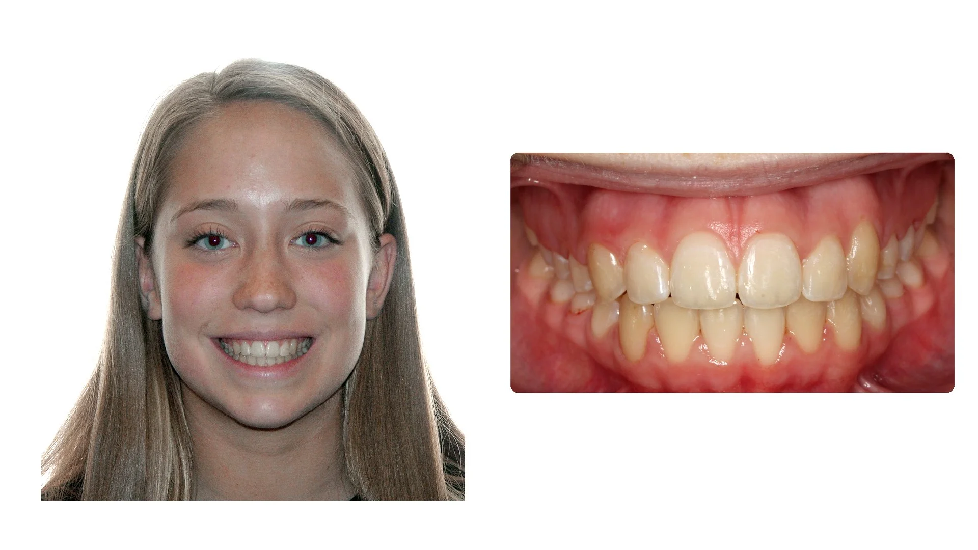 Morgan after braces photo
