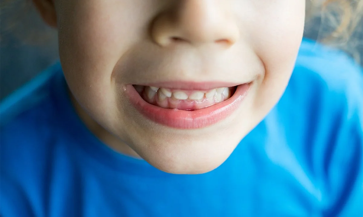 Bite Correction: Understanding Overbites, Underbites, and Crossbites