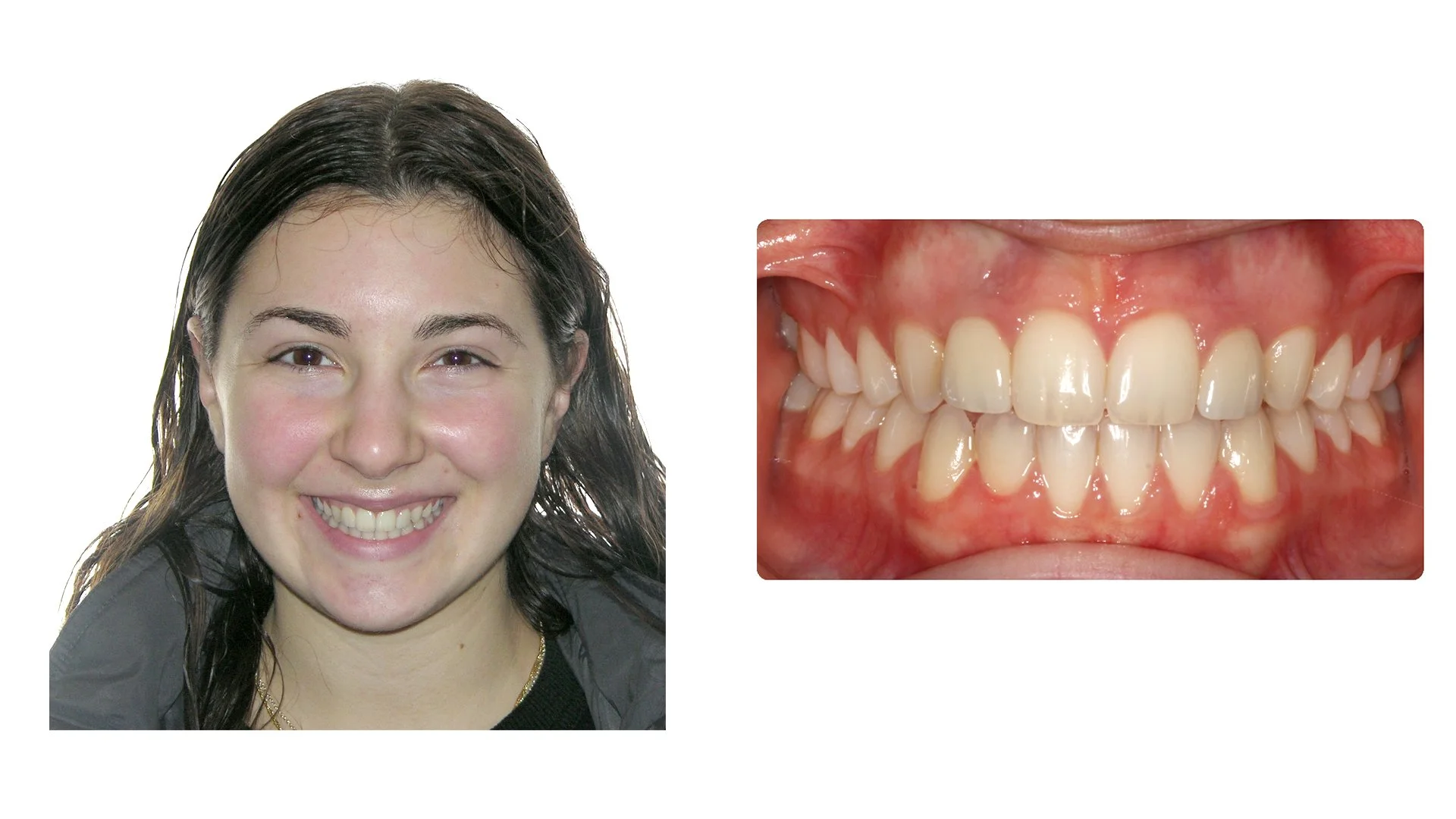 Daniela before braces photo