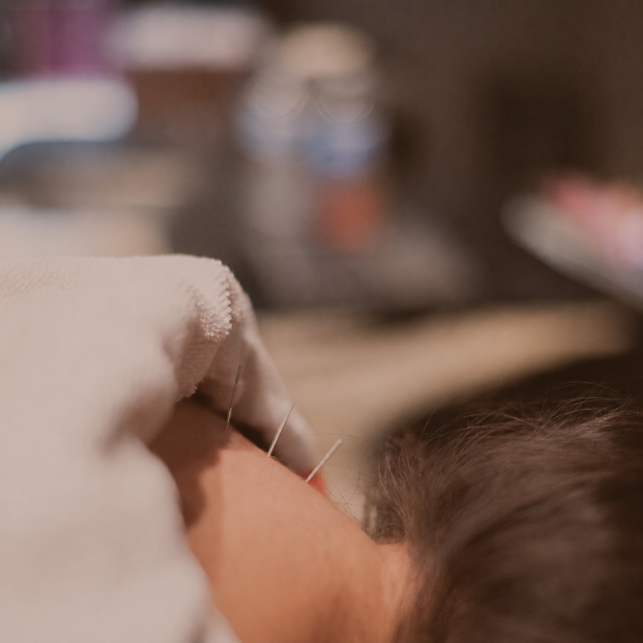 Dry Needling: Before and After – What Changes Can You Expect?