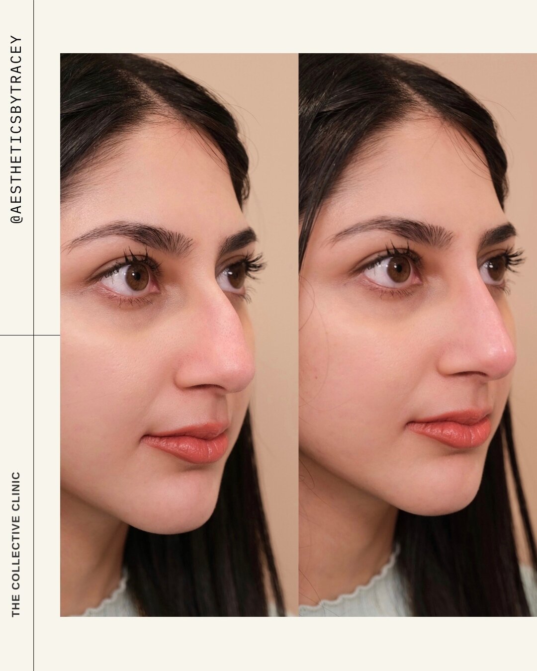 Have you been thinking about nose filler? 👃🏼⁠
⁠
Nose filler AKA non-surgical rhinoplasty or liquid rhinoplasty, is a cosmetic injectable procedure where dermal fillers are injected into the nose to reshape and enhance its appearance to address mino