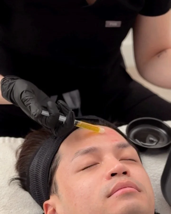 Platelet Rich Fibrin (PRF) is not about instant change. It is about working with your skin over time.

We&rsquo;ve added PRF to our regenerative medicine toolkit. Similar to Platelet Rich Plasma (PRP), PRF uses your body&rsquo;s own components and is