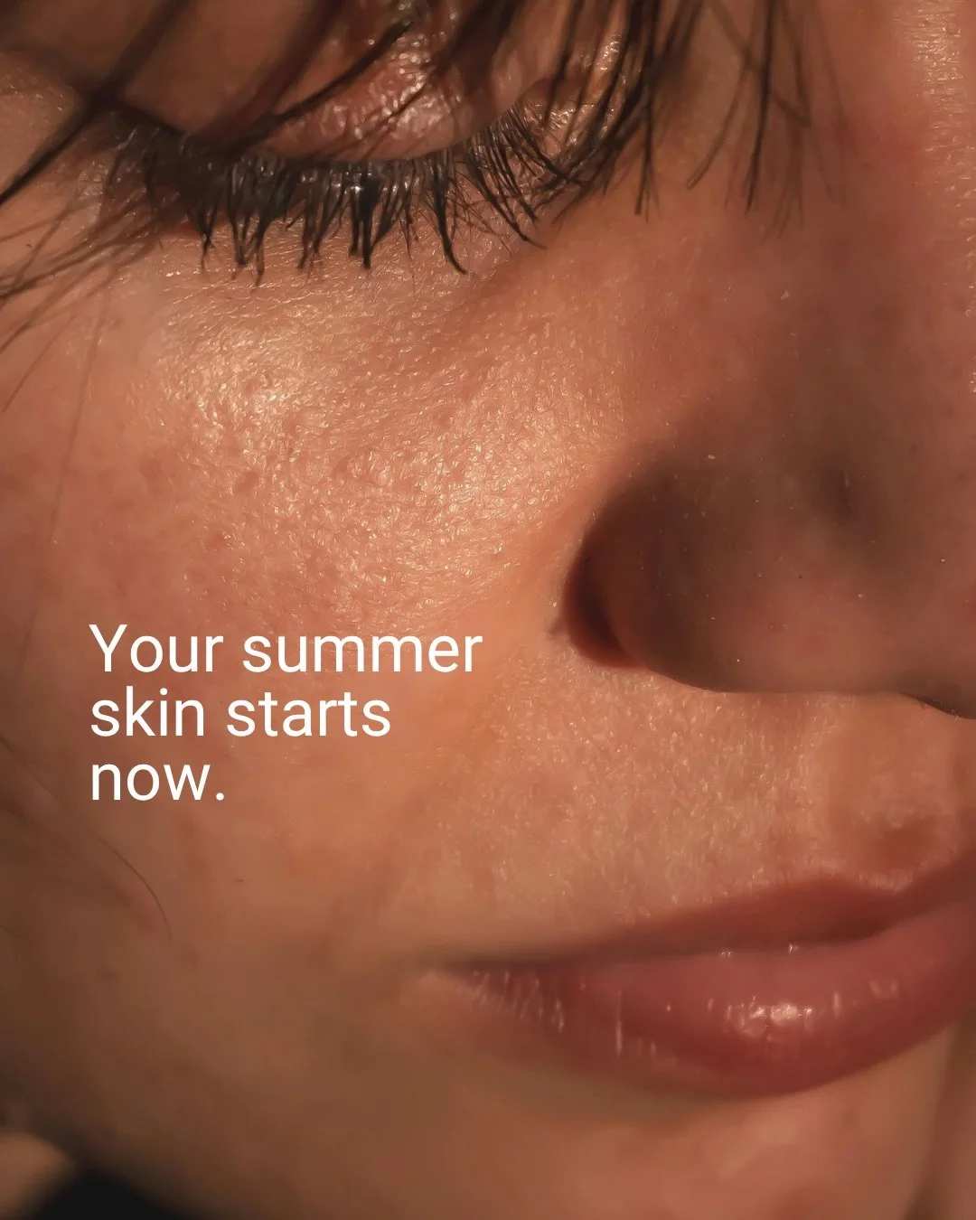 Your summer skin starts now. If you have been thinking about doing something for your skin before summer. April is the time to act.

Biostimulators work from the inside out. Rather than adding volume immediately, they signal your skin to rebuild its 